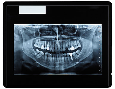 牙齿成像射电图射线医学药店骨骼治愈科学下颌医院x射线牙科图片