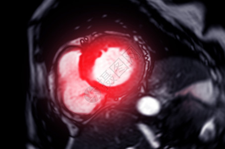 心肌梗塞或心肺复苏攻击扫描核磁共振心血管胸痛诊断中风有氧运动射线胸部图片