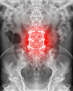 隆巴脊椎的X光图像 与冰球螺丝固定外科神经金属板腰背脊柱柱子替代品治疗科学疾病图片