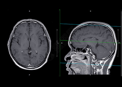 MRI 脑轴和人文平面 带有对比度图片