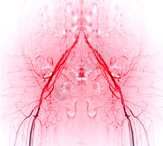 女性动脉的PTA 切口性转光血管成形术图片