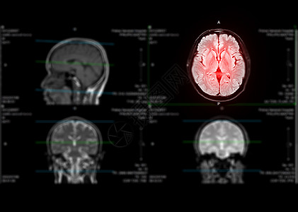 用于检测中风疾病和脑肿瘤及细胞细胞的核磁共振大脑轴心能力图片