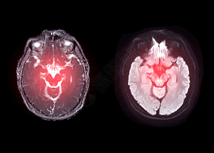 医学影像用于检测中风疾病以及脑肿瘤和细胞的 MRI 大脑轴心扩散图像背景