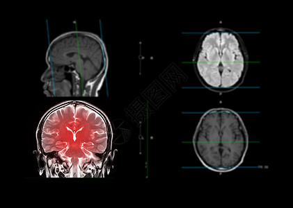 神经外科核磁共振大脑显示大脑的日冕平面背景