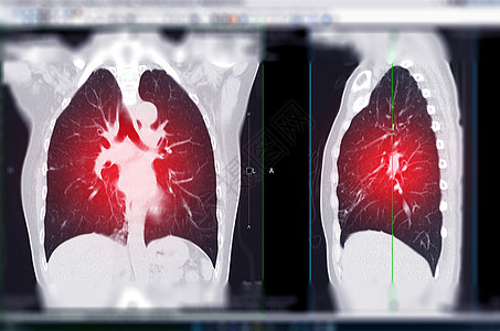 CT 肺科和人表的胸腔或胸部扫描图片