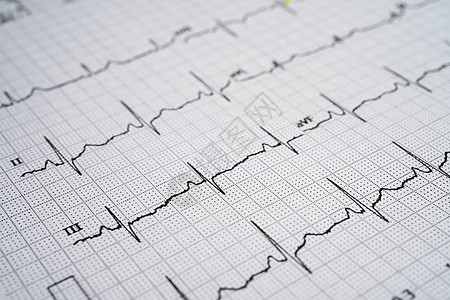 心电图心电图与红心 心波 心脏病发作 心电图报告图片