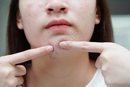 皮肤脸部的骨灰和伤疤 塞巴塞氏腺紊乱 少女皮肤护理美容问题化妆品产品瘢痕肤色疙瘩前额女性皮脂腺治疗皮肤科图片