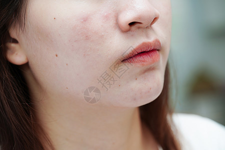 皮肤脸部的骨灰和伤疤 塞巴塞氏腺紊乱 少女皮肤护理美容问题前额产品毛孔疾病卫生药品瘢痕化妆品女性青春期图片