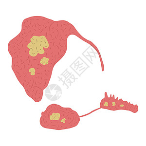 血清腺中石块的矢量图 Sialolith病图片