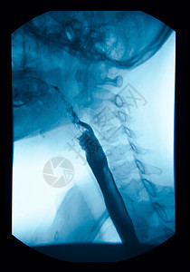 X射线高肠胃肠 UGI Esophagram 医师 食管图片