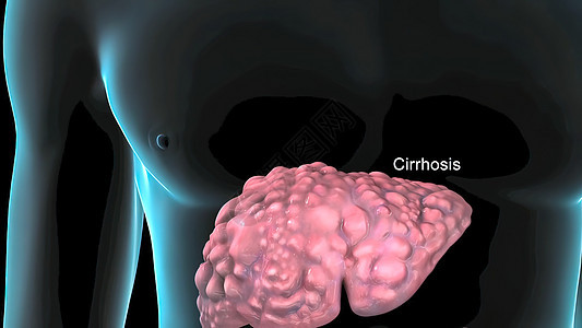 硬化是肝脏长期和持续受损的结果 因此导致出现慢性硬化 痛苦 病毒图片