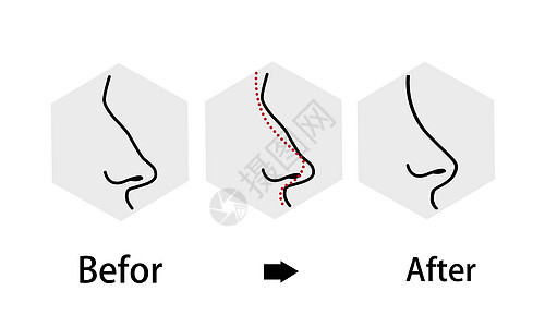 鼻子整形修复过程背景图片