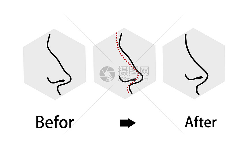 鼻子整形修复过程图片