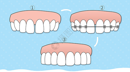牙齿纠正矢量图美牙仪高清图片