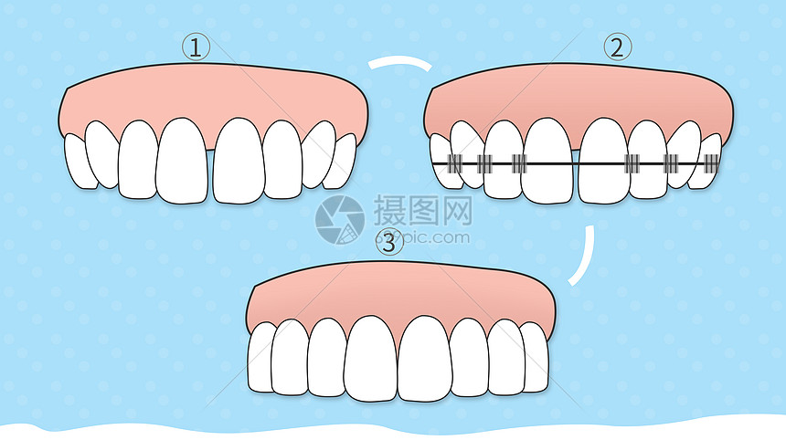 牙齿纠正图片