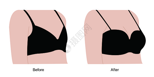 美容形体隆胸变大高清图片