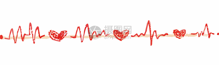 24小时动态心电图图片,动态心电图安装位置图 正版 gif动态图片下载,该 gif动态图片 标题为 心电图分割