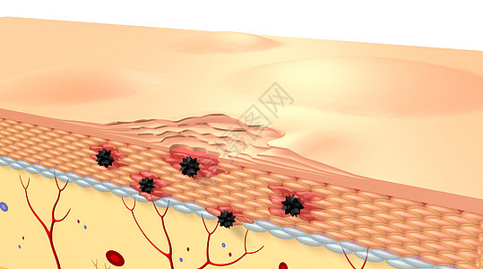 皮肤病变场景图片