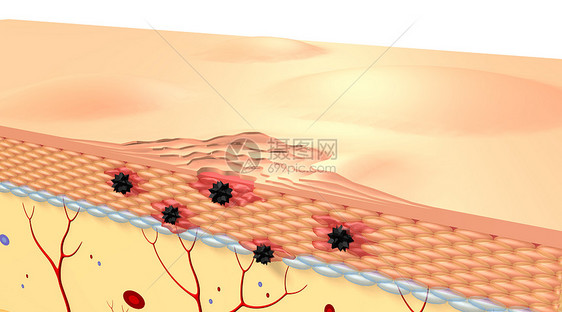 皮肤病变场景图片