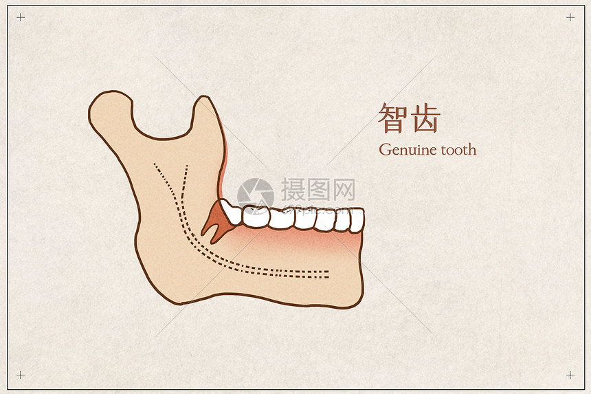 阻生智齿医疗插画示意图图片