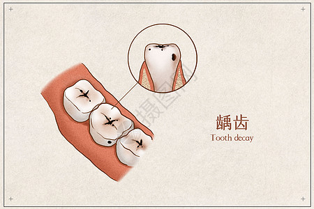 龋齿医疗插画示意图高清图片