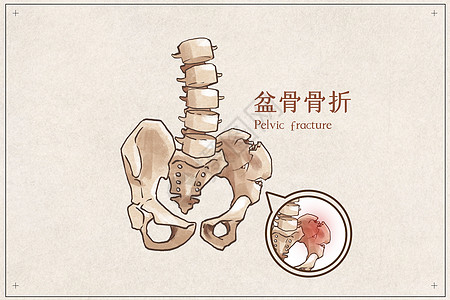 盆骨骨折示意图高清图片