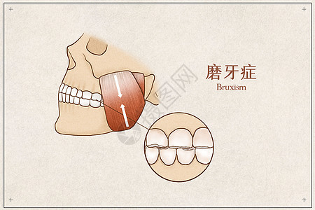 磨牙症医疗插画示意图图片