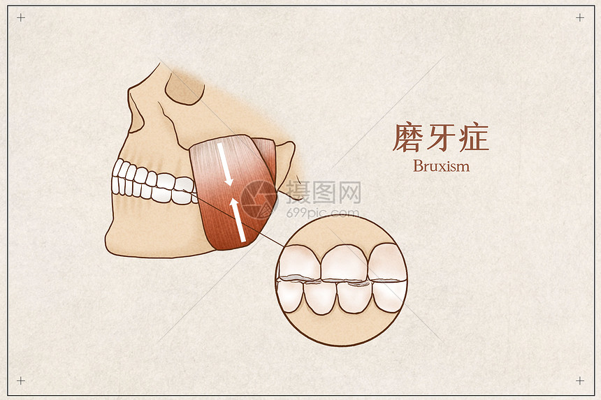 磨牙症医疗插画示意图图片