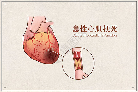 急性心肌梗死医疗插画示意图高清图片