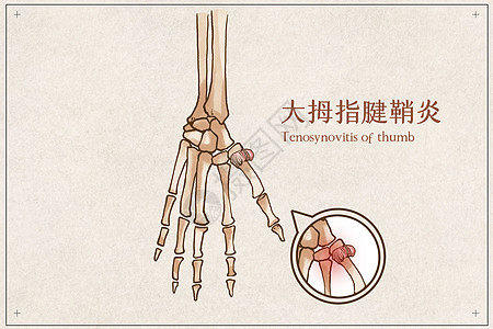 大拇指腱鞘炎示意图高清图片