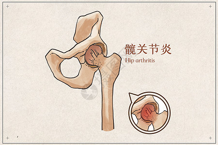 髋关节炎示意图图片