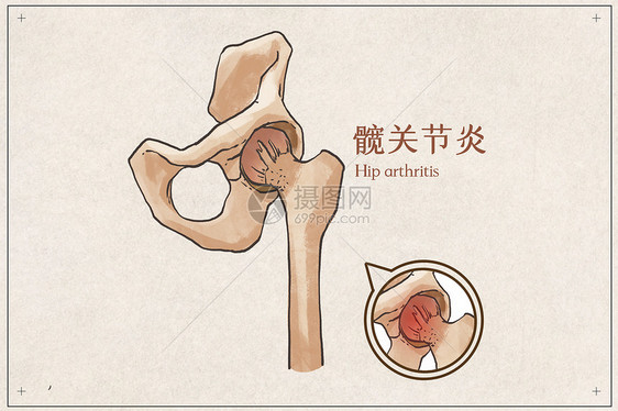 髋关节炎示意图图片