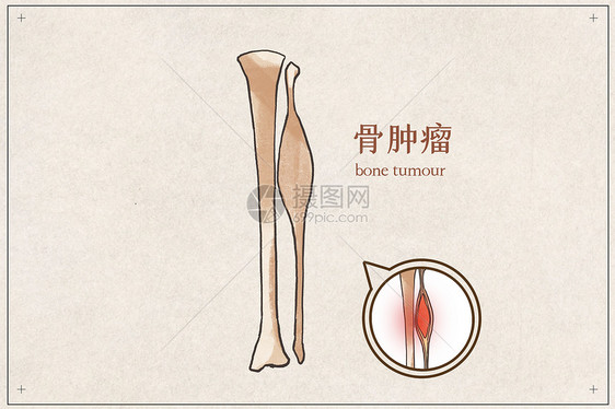 骨肿瘤示意图图片