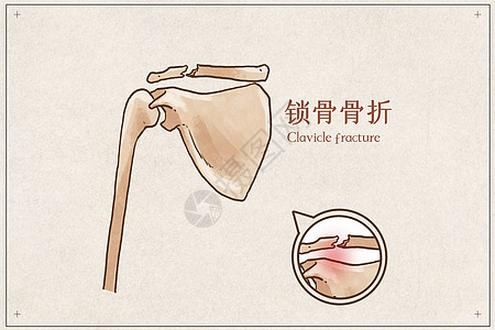 锁骨骨折示意图图片