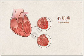 心肌炎医疗插画示意图心脏高清图片素材