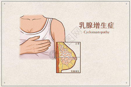 乳腺疾病乳腺增生症医疗插画示意图插画