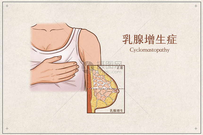 乳腺增生症医疗插画示意图图片