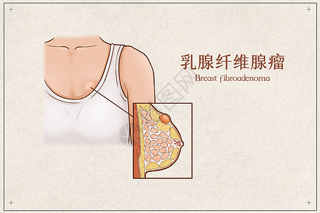 女性腹部乳腺纤维腺瘤医疗插画示意图插画