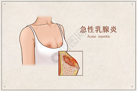 急性乳腺炎医疗插画示意图图片