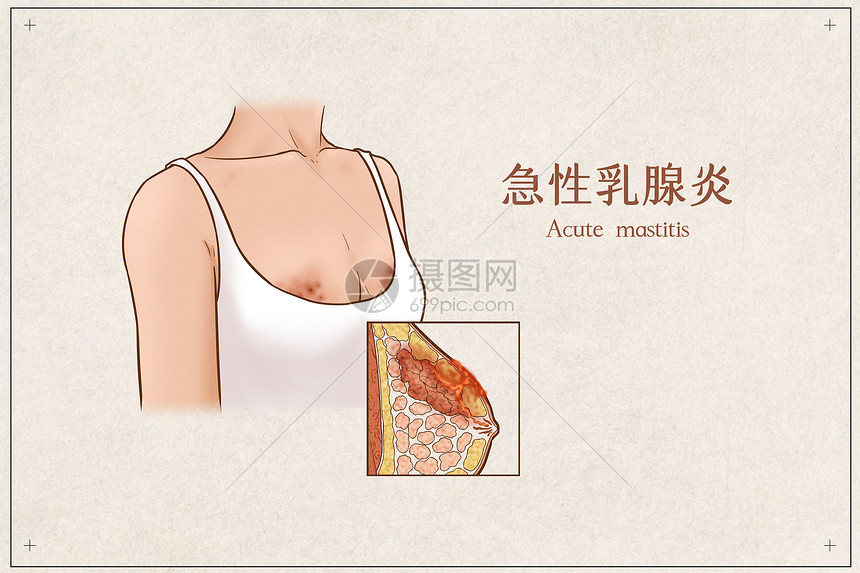 急性乳腺炎医疗插画示意图图片