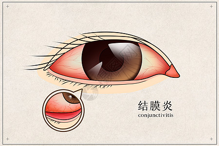 结膜炎医疗插画背景图片