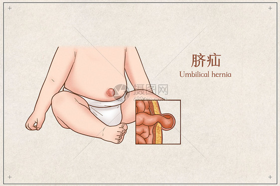 脐疝医疗插画图片