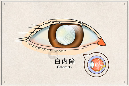 眼睛白内障医疗插画插画