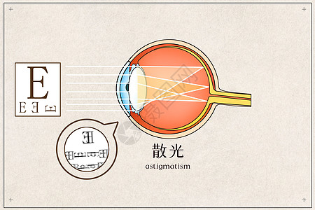 散光医疗插画高清图片