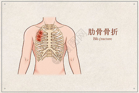 肋骨骨折医疗插画背景图片