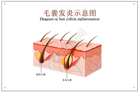 真皮毛囊发炎示意图插画