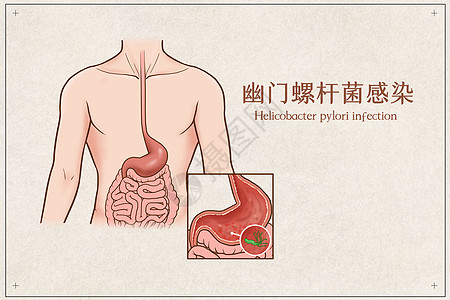 幽门螺杆菌感染医疗插画高清图片