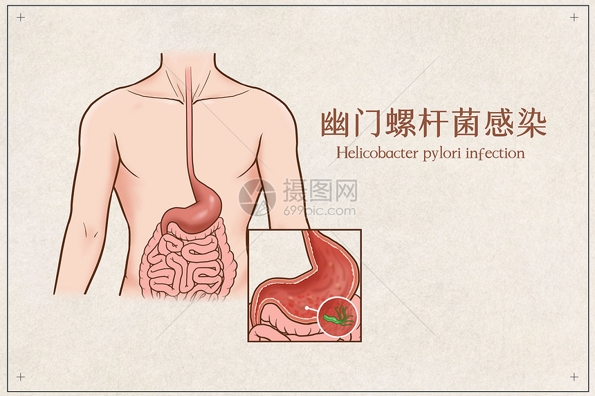 幽门螺杆菌感染医疗插画图片