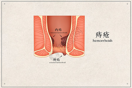 痔疮医疗插画背景图片