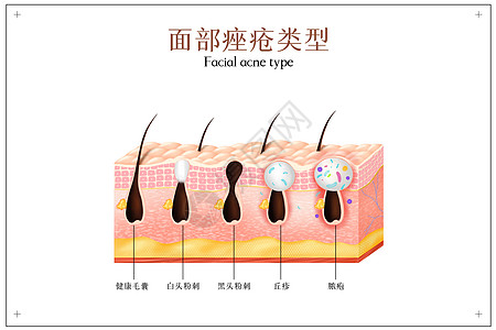 真皮面部痤疮类型插画